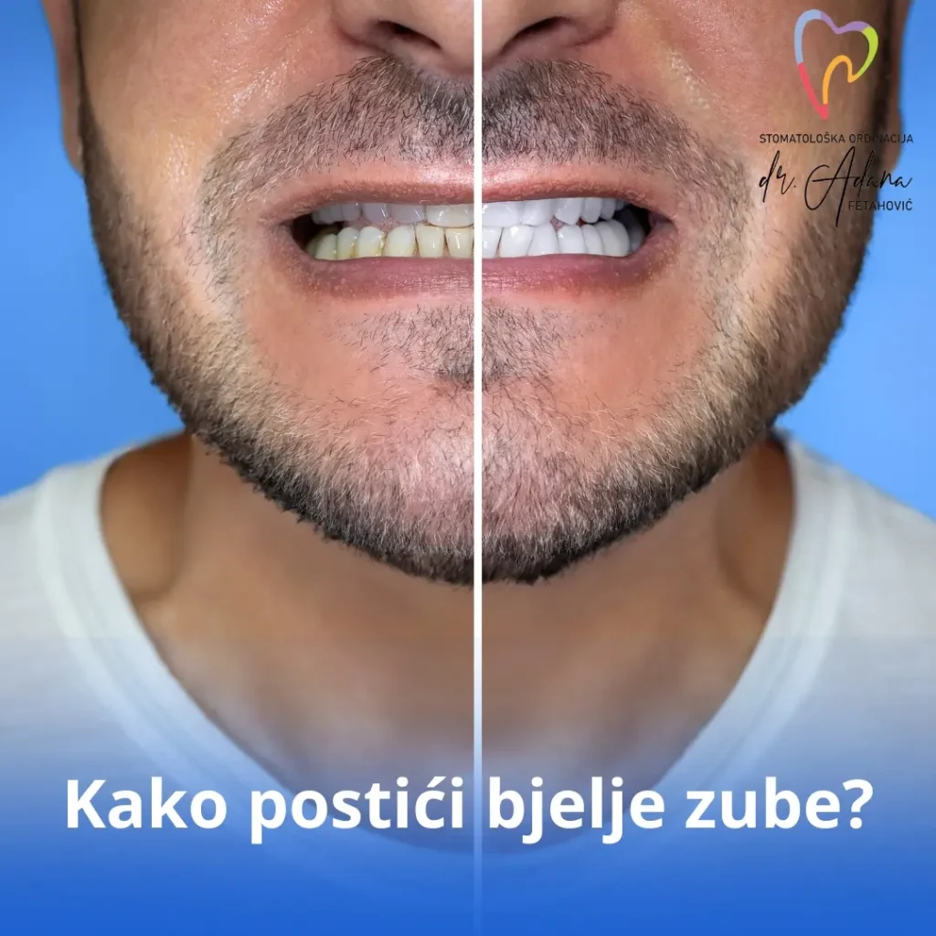 Kako postići bjelje zube?