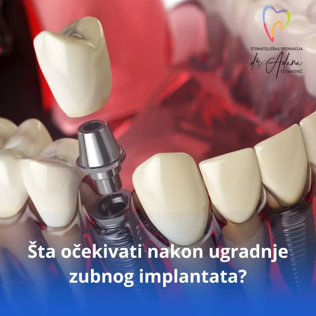 https://xn--dradanafetahovi-f1b.com/sta-ocekivati-nakon-ugradnje-zubnog-implantata/